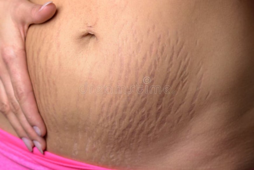 Safety Tips For Stretch Marks Removal